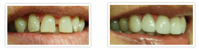 straighten invisalign