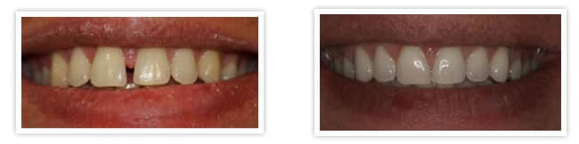 straighten teeth invisalign 1 copy