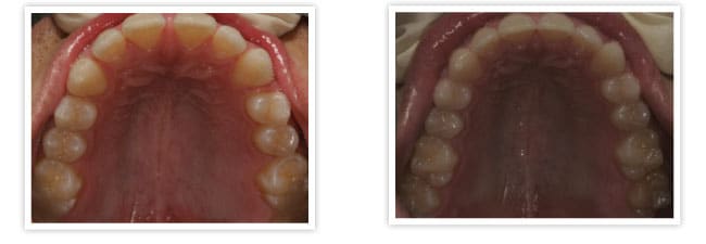 Teeth Straightening Procedures in Austin TX, The Hills Dental Spa