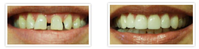 straighten teeth veneers 1 copy