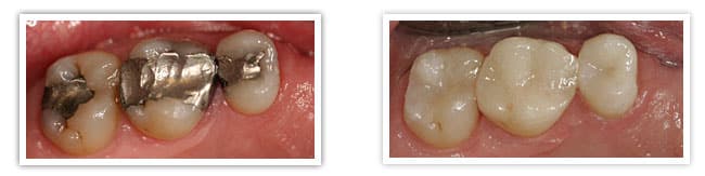 Dental Crowns In Austin, TX