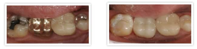 metal free dentistry crowns before and after tooth colored fillings photo