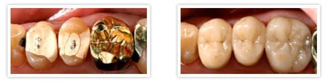 Before and after photos of bad fillings and metal crowns replaced with tooth colored fillings