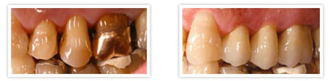 Before and after mercury free dentistry in Austin TX