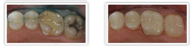 metal free dentistry tooth colored fillings