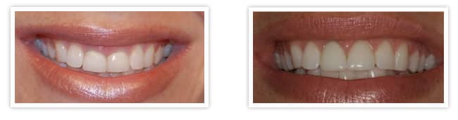 before and after gum shaping contouring the hills dental spa austin texas 1