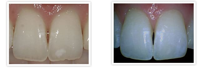 repair chipped teeth detrick