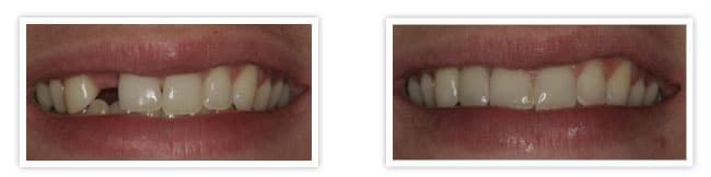 replace missing teeth implants 1