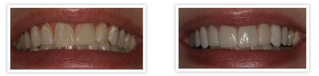 whiter teeth veneers2