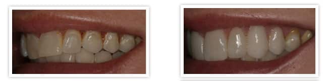 whiter teeth veneers3