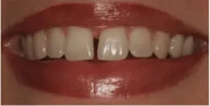 veneers1.png