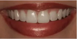 veneers2.png